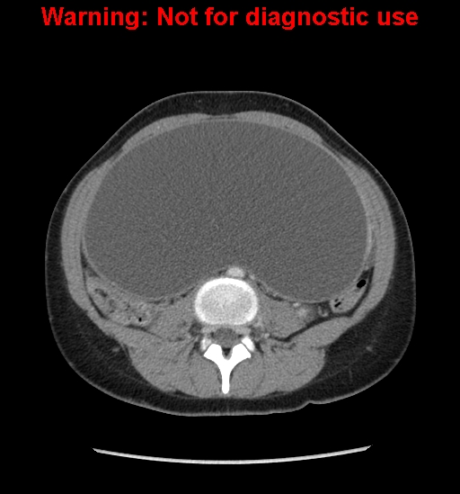 Borderline mucinous cystadenoma of ovary (Radiopaedia 25586-25767 A 39).jpg