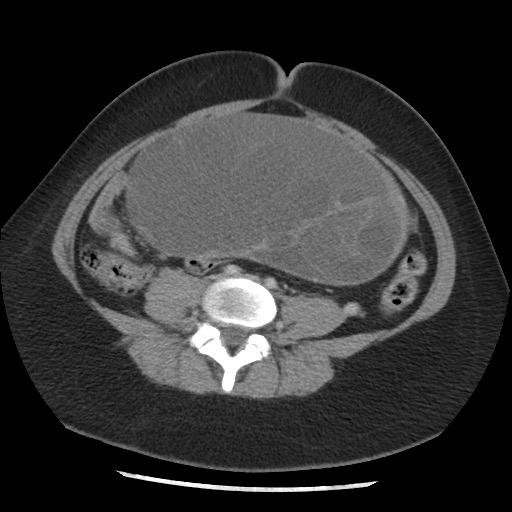File:Borderline mucinous tumor (ovary) (Radiopaedia 78228-90808 A 103).jpg