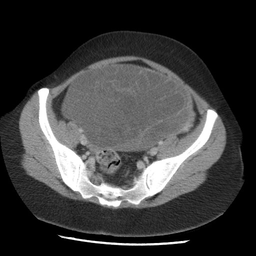 File:Borderline mucinous tumor (ovary) (Radiopaedia 78228-90808 A 119).jpg
