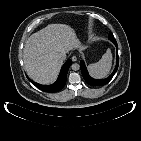 Bosniak renal cyst - type IV (Radiopaedia 24244-24518 Axial non-contrast 56).jpg