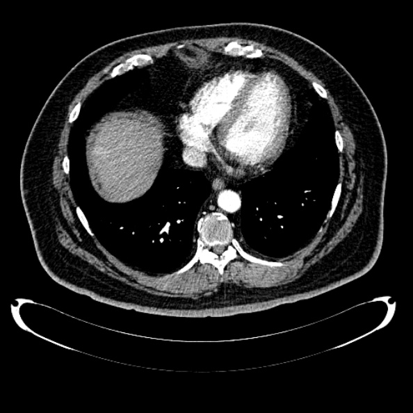 Bosniak renal cyst - type IV (Radiopaedia 24244-24518 B 9).jpg