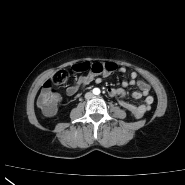 Bosniak renal cyst - type I (Radiopaedia 27479-27675 renal cortical phase 51).jpg