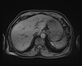 Bouveret syndrome (Radiopaedia 61017-68856 Axial T1 fat sat 16).jpg
