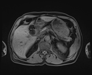 Bouveret syndrome (Radiopaedia 61017-68856 Axial T1 fat sat 28).jpg