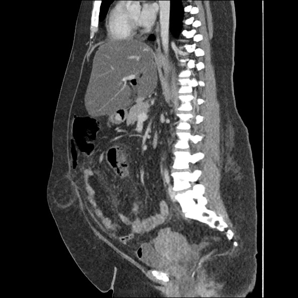 Bowel and splenic infarcts in acute lymphocytic leukemia (Radiopaedia 61055-68915 C 34).jpg