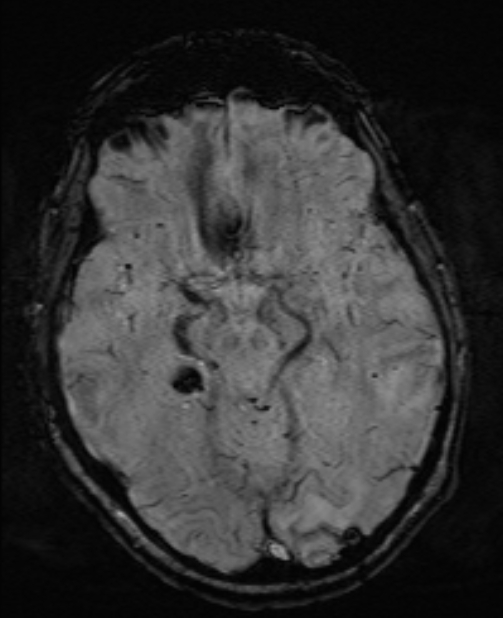 Brain metastases - lung cancer primary (Radiopaedia 75060-86115 Axial SWI 27).jpg