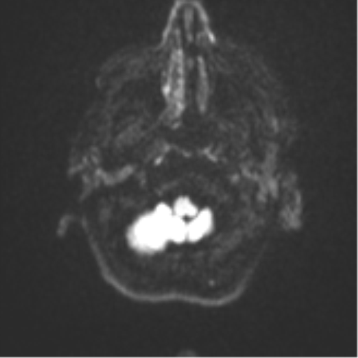 Brain metastasis (sarcoma) (Radiopaedia 47576-52209 Axial DWI 31).png