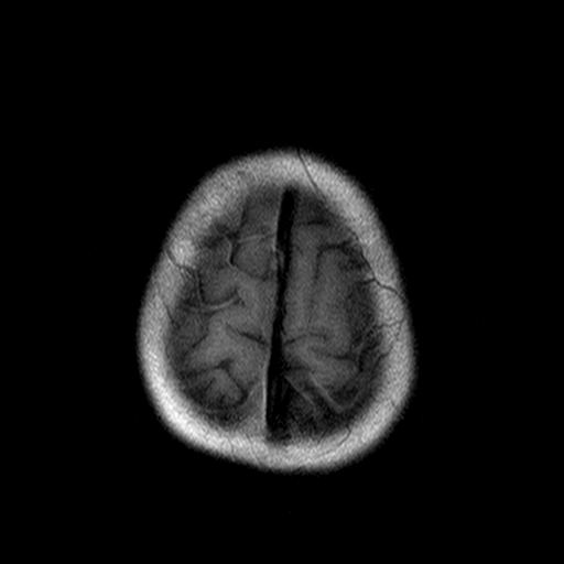 File:Brainstem ganglioglioma (Radiopaedia 10763-11224 Axial T1 2).jpg