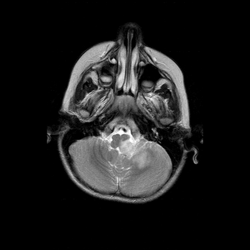 File:Brainstem ganglioglioma (Radiopaedia 10763-11224 Axial T2 16).jpg
