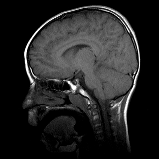 File:Brainstem ganglioglioma (Radiopaedia 10763-11224 Sagittal T1 9).jpg