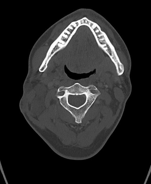 Branchial cleft cyst (Radiopaedia 31167-31875 Axial bone window 26).jpg