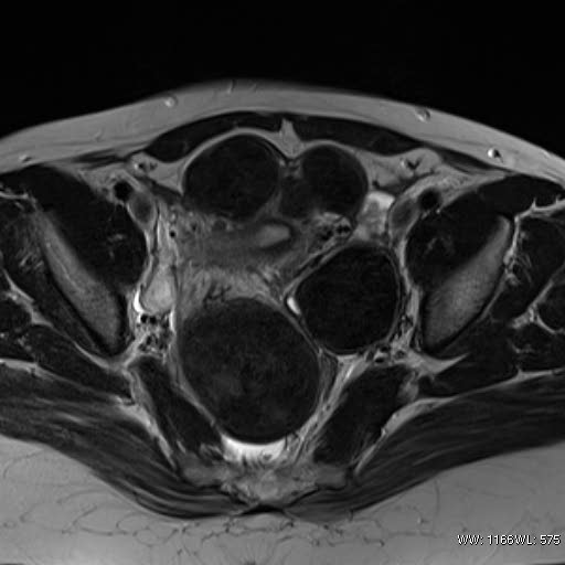 File:Broad ligament fibroid (Radiopaedia 49135-54241 Axial T2 17).jpg