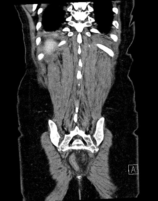 Broad ligament hernia (Radiopaedia 84802-100276 B 3).jpg