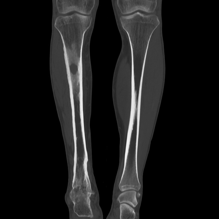 Brodie abscess - tibia (Radiopaedia 66028-75204 Coronal bone window 26).jpg