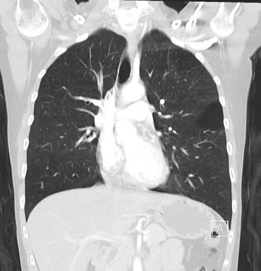 File:Bronchial atresia (Radiopaedia 73677-84470 Coronal lung window 15).jpg