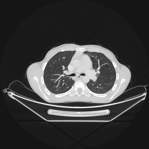Bronchial carcinoid tumor (Radiopaedia 57187-64090 Axial lung window 28).jpg