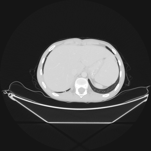 Bronchial carcinoid tumor (Radiopaedia 57187-64090 Axial lung window 71).jpg