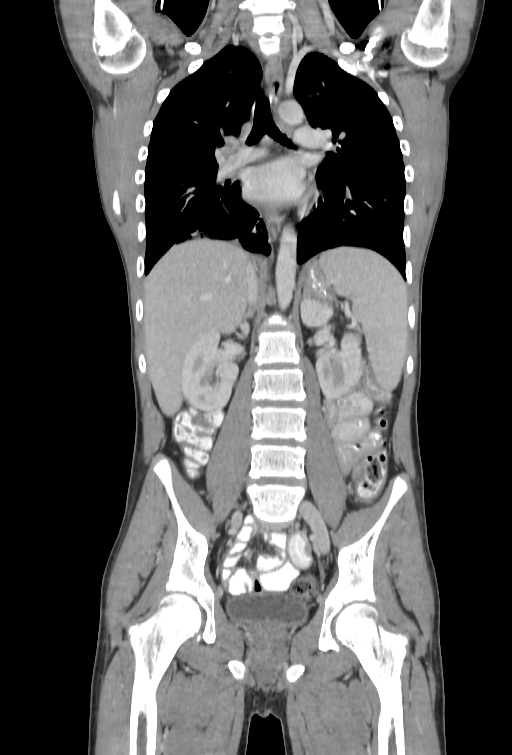 Bronchial carcinoid tumor (Radiopaedia 57187-64090 B 61).jpg