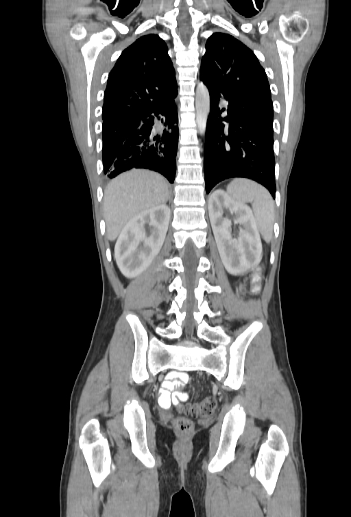 Bronchial carcinoid tumor (Radiopaedia 57187-64090 B 86).jpg