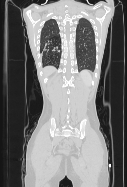 Bronchial carcinoid tumor (Radiopaedia 57187-64090 Coronal lung window 93).jpg