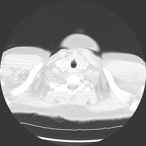 Bronchial carcinoid tumor (Radiopaedia 67377-76764 Axial lung window 4).jpg