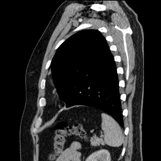 Bronchial carcinoid tumor (Radiopaedia 67377-76764 E 56).jpg