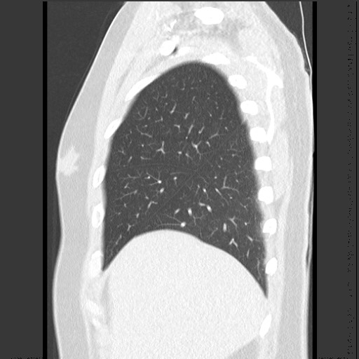Bronchial carcinoid tumor (Radiopaedia 67377-76764 Sagittal lung window 13).jpg