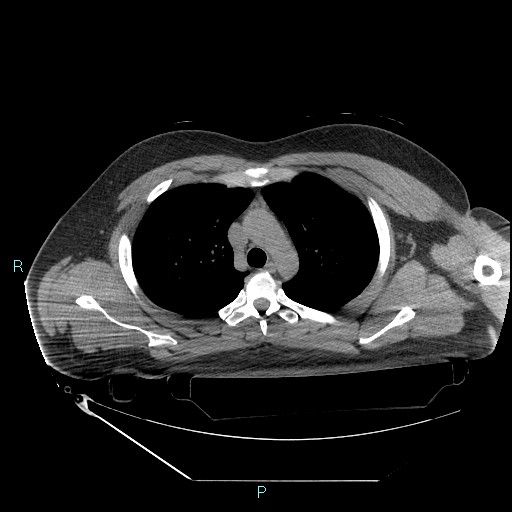 Bronchial carcinoid tumor (Radiopaedia 78272-90870 Axial non-contrast 31).jpg