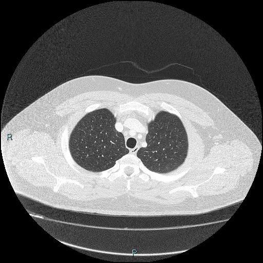 Bronchial carcinoid tumor (Radiopaedia 78272-90875 Axial lung window 8).jpg