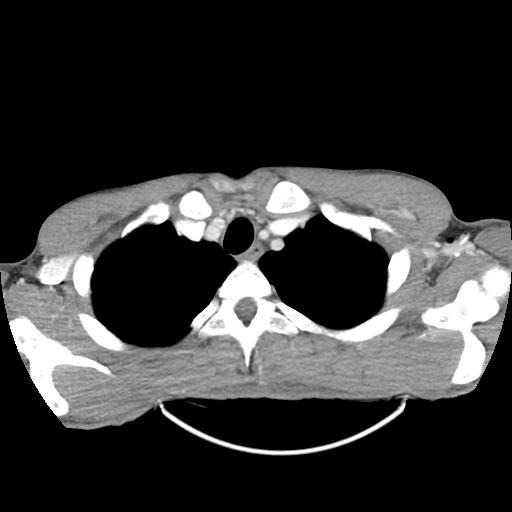 Bronchial carcinoid tumor causing right lower lobe collapse (Radiopaedia 83495-98594 A 4).jpg