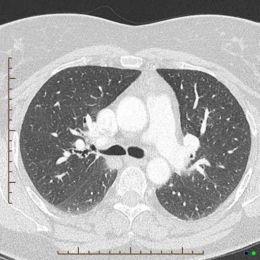File:Bronchial diverticula (Radiopaedia 79512-92676 Axial lung window 71).jpg