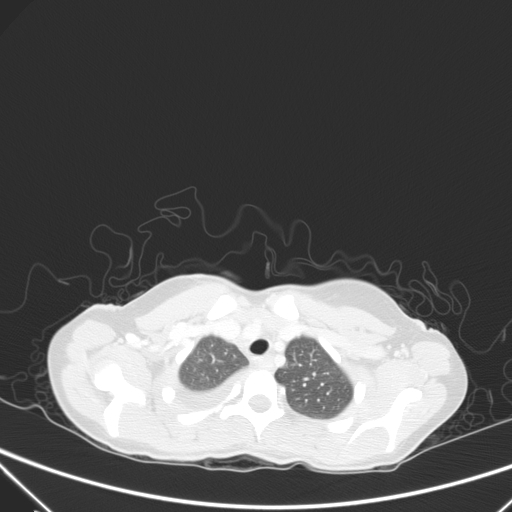 Bronchial mucoepidermoid carcinoma (Radiopaedia 57023-63895 Axial lung window 11).jpg