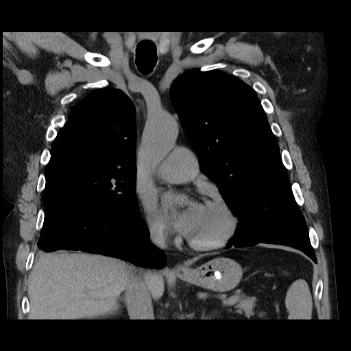 Bronchial stenosis - lung transplant (Radiopaedia 73133-83848 Coronal non-contrast 32).jpg
