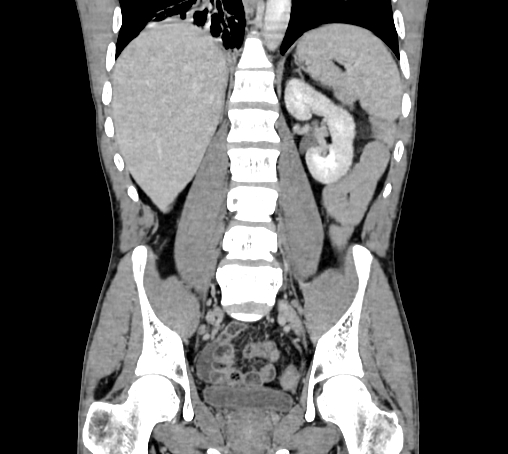 Bronchiectasis in Crohn disease (Radiopaedia 60311-67977 C 52).jpg