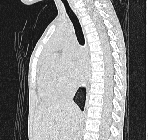 Bronchiolitis obliterans (Radiopaedia 71538-81897 Sagittal lung window 33).jpg