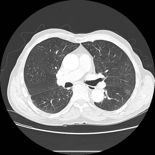 Bronchocele (Radiopaedia 17097-16795 Axial lung window 56).jpg