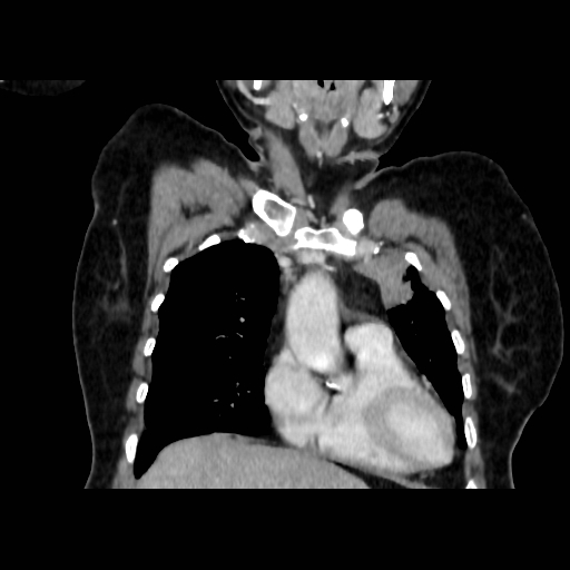 Bronchogenic carcinoma (Radiopaedia 73497-84262 C 44).jpg