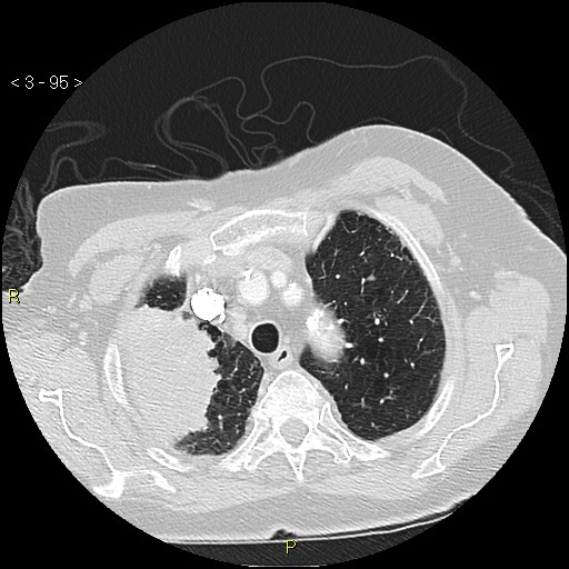Bronchogenic carcinoma as an incidental finding (Radiopaedia 16453-16130 Axial lung window 95).jpg