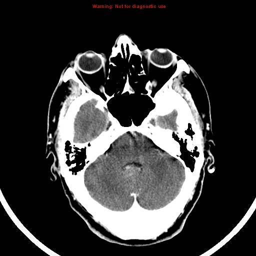 File:Bronchogenic carcinoma brain metastasis (Radiopaedia 9286-9970 B 7).jpg