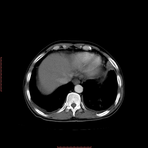 File:Bronchogenic carcinoma with left atrial large deposit - T4N3M1a (Radiopaedia 42316-45428 A 24).jpg