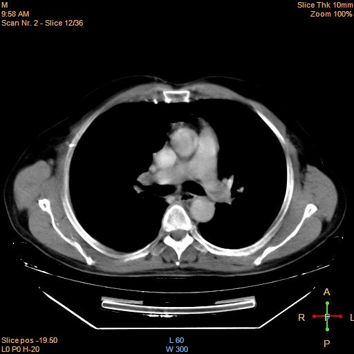 File:Bronchogenic carcinoma with superior vena caval invasion (Radiopaedia 22378-22406 Axial liver window 10).jpg