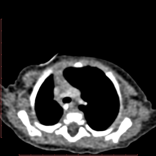 Bronchogenic cyst (Radiopaedia 78599-91409 B 60).jpg