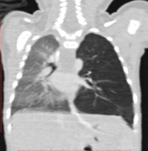 Bronchogenic cyst (Radiopaedia 78599-91409 Coronal lung window 138).jpg
