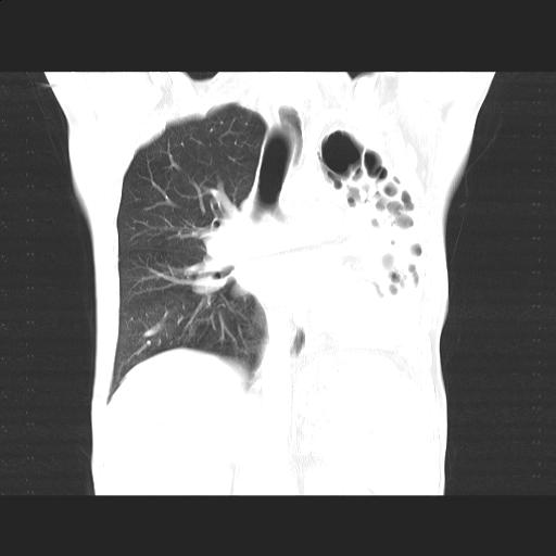 File:Bronchopleural fistula secondary to tuberculosis (Radiopaedia 20415-20322 Coronal lung window 11).jpg