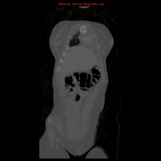 File:Brown tumor (Radiopaedia 12318-12596 D 15).jpg