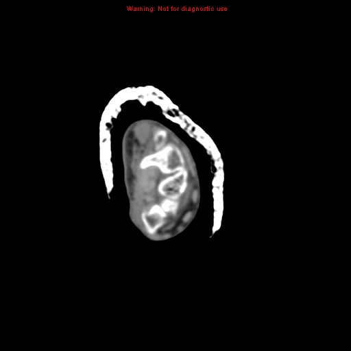 Brown tumor (Radiopaedia 12460-12694 Axial non-contrast 5).jpg