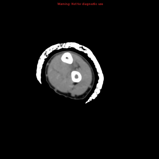 File:Brown tumor (Radiopaedia 12460-12694 Axial non-contrast 98).jpg