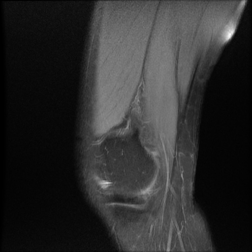 File:Bucket-handle meniscus tear (Radiopaedia 65700-74809 Sagittal PD fat sat 4).jpg