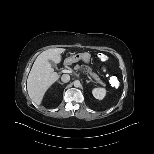 File:Buried bumper syndrome - gastrostomy tube (Radiopaedia 63843-72575 A 17).jpg
