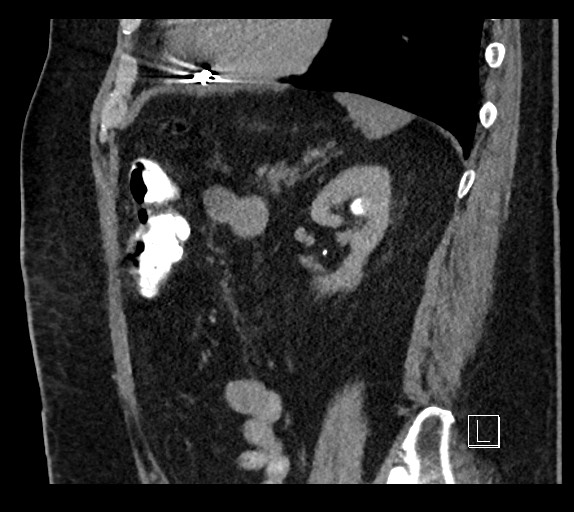 Buried bumper syndrome - gastrostomy tube (Radiopaedia 63843-72577 Sagittal Inject 37).jpg